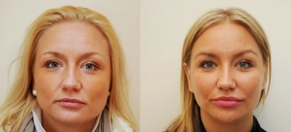 Эндоскопическая подтяжка лица - больше вреда или пользы?