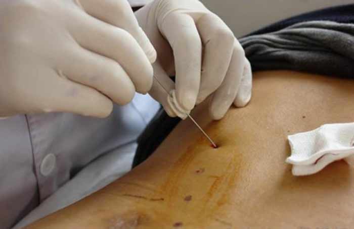 Игла-нож – изобретение китайских врачей