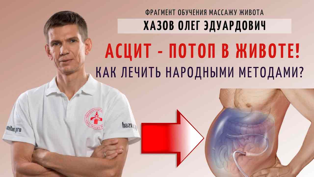 Асцит - что это? Симптомы, лечение, причины