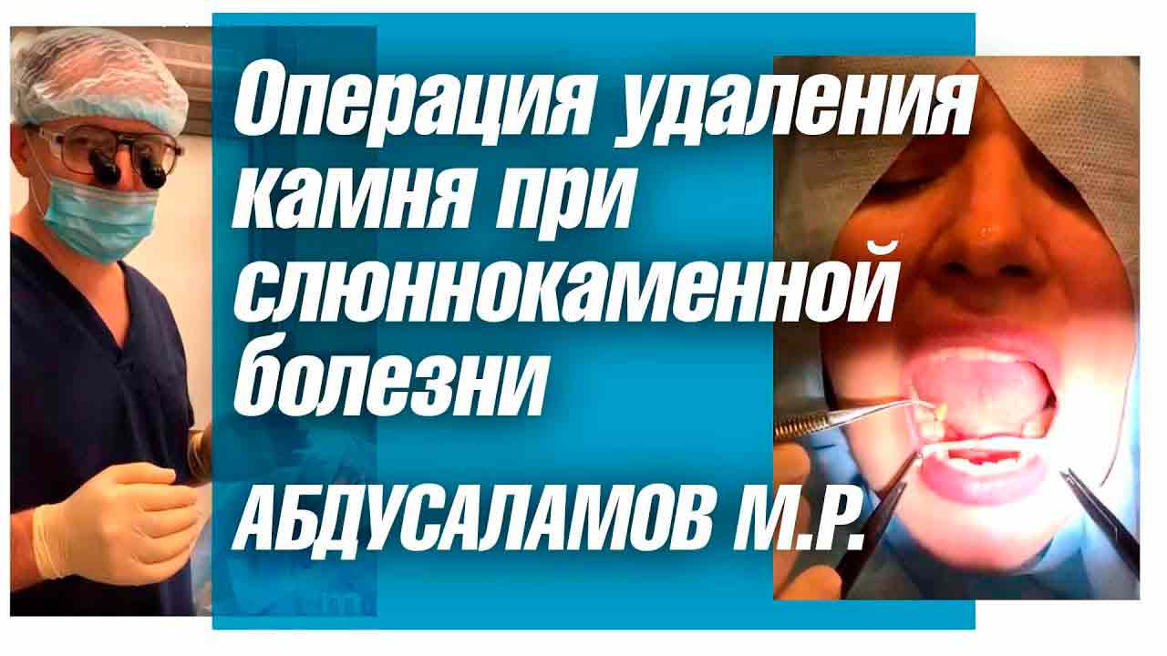 Камни слюнных желез - причины, симптомы, лечение