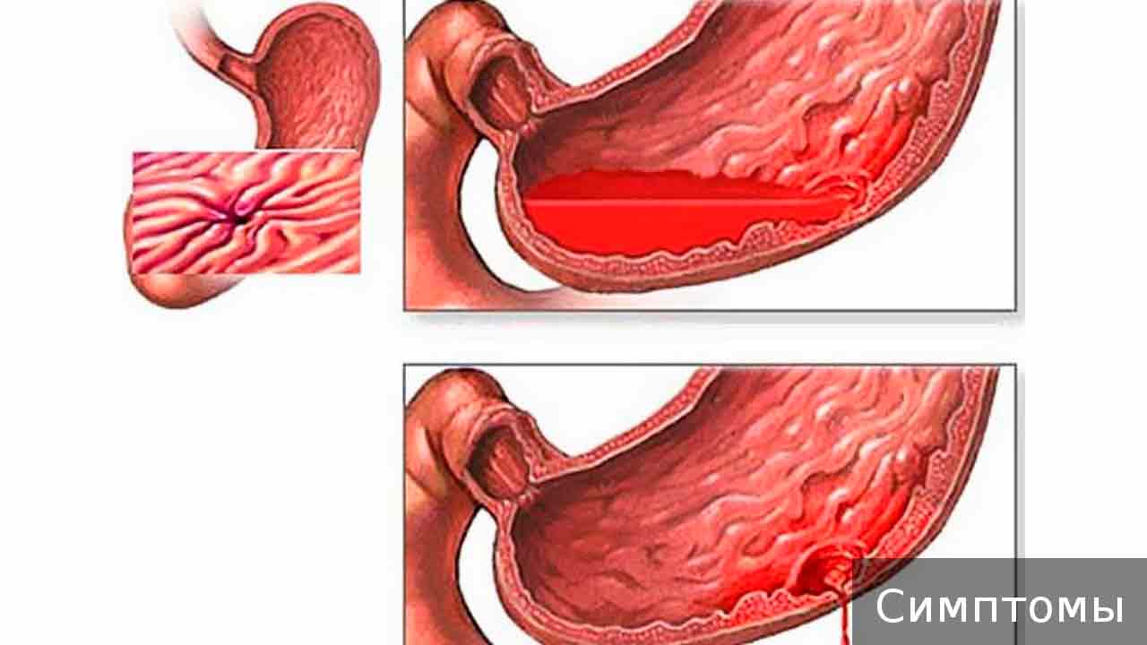 Ректальное кровотечение - причины, лечение, осложнения