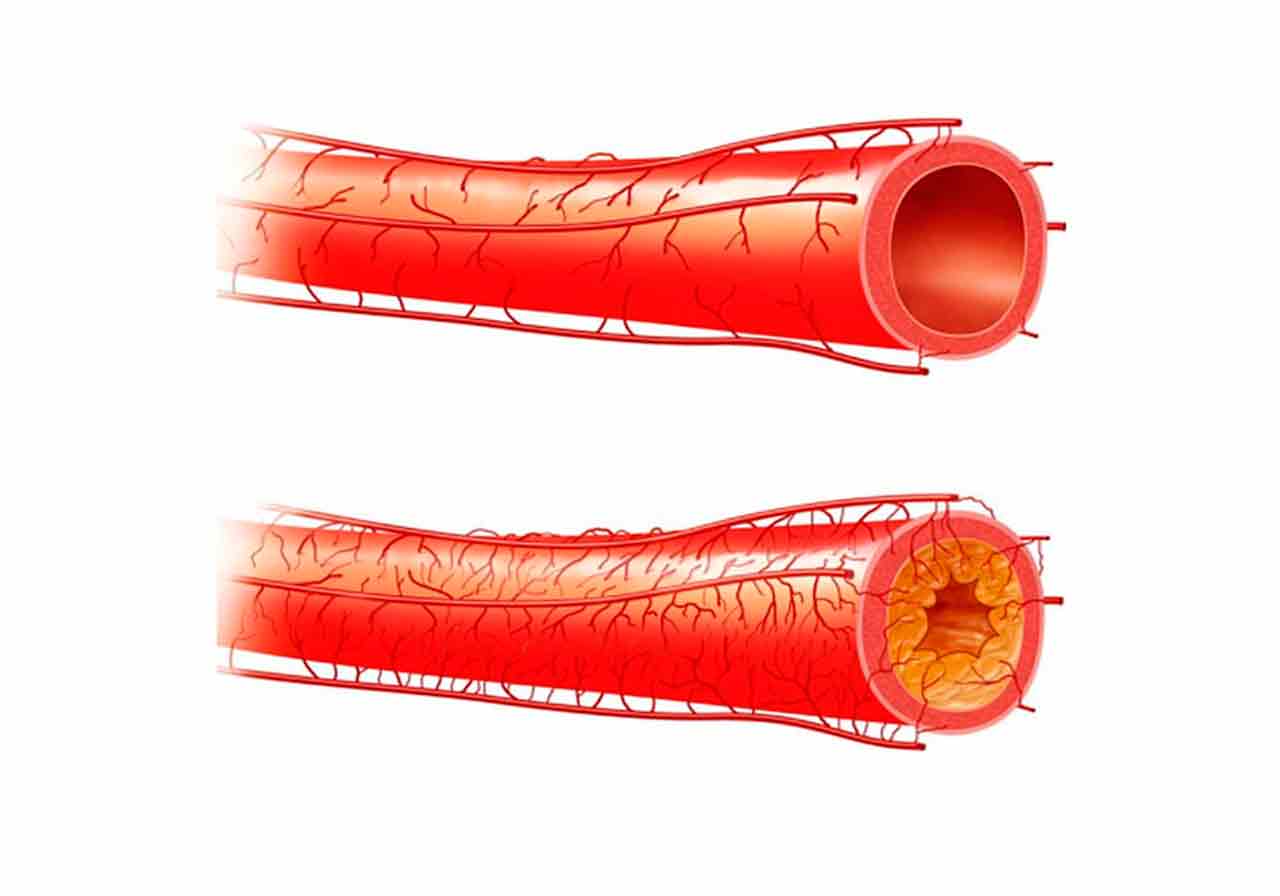 Артериосклероз - что это такое?