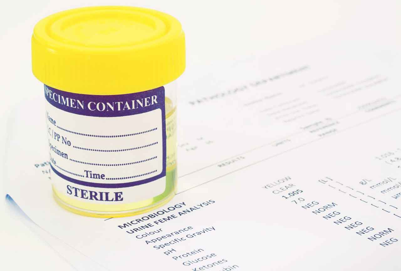 Мутная моча - каковы ее причины