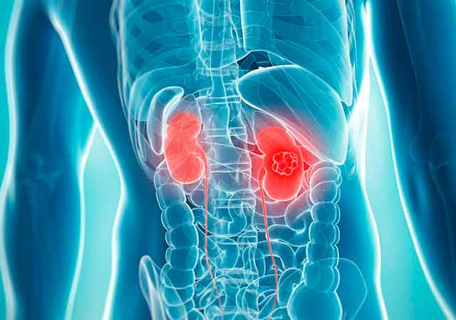 Рак почки. Каков прогноз?