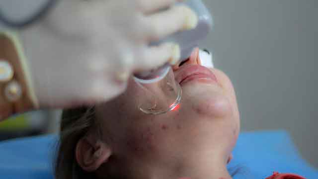 Прыщи на лице подростков: чем отличаются у девочек и мальчиков?